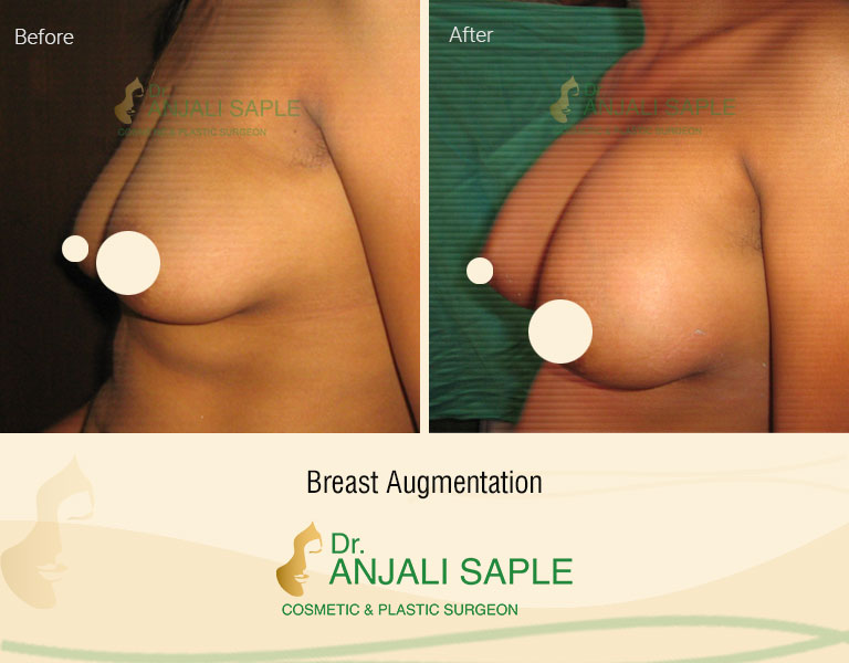 Breast Augmentation Left Side View