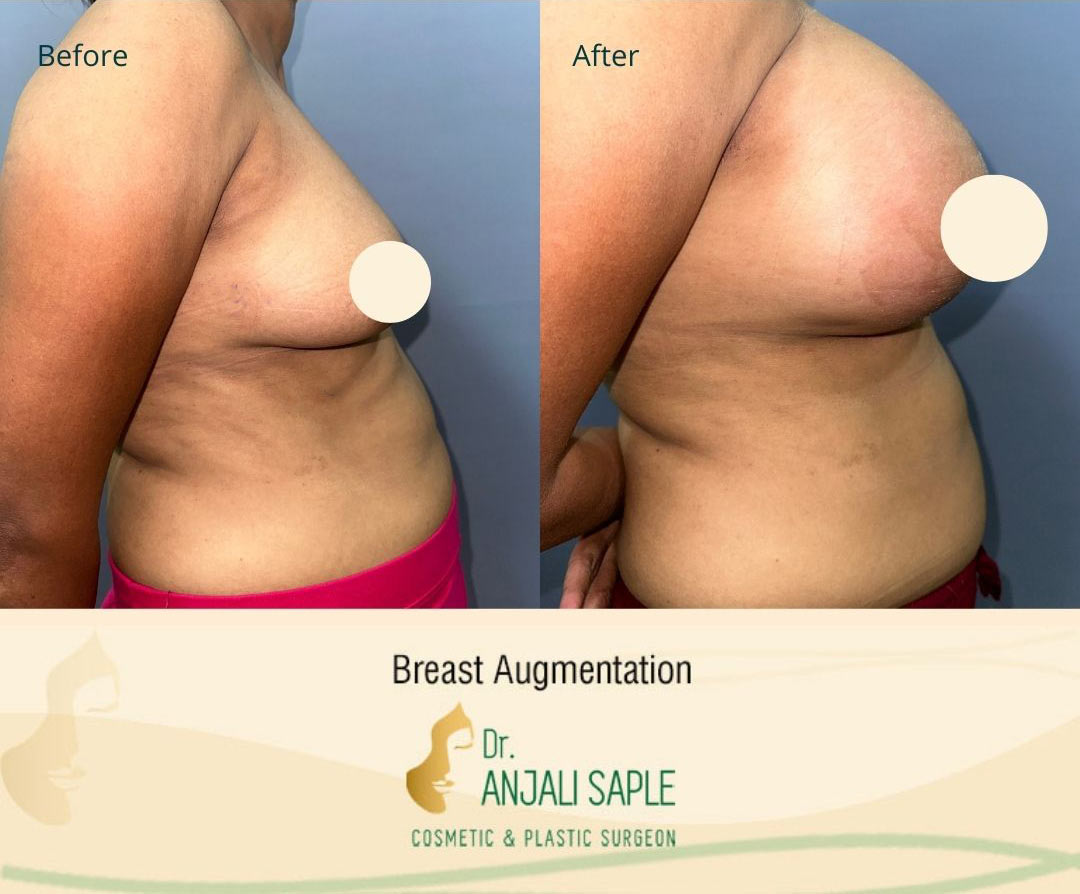 Breast Augmentation Right Side View