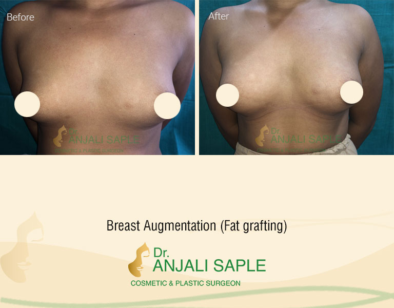 Breast Augmentation Left View