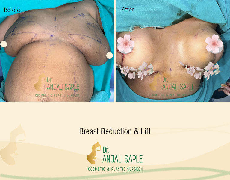 Breast Reduction & lift Front View