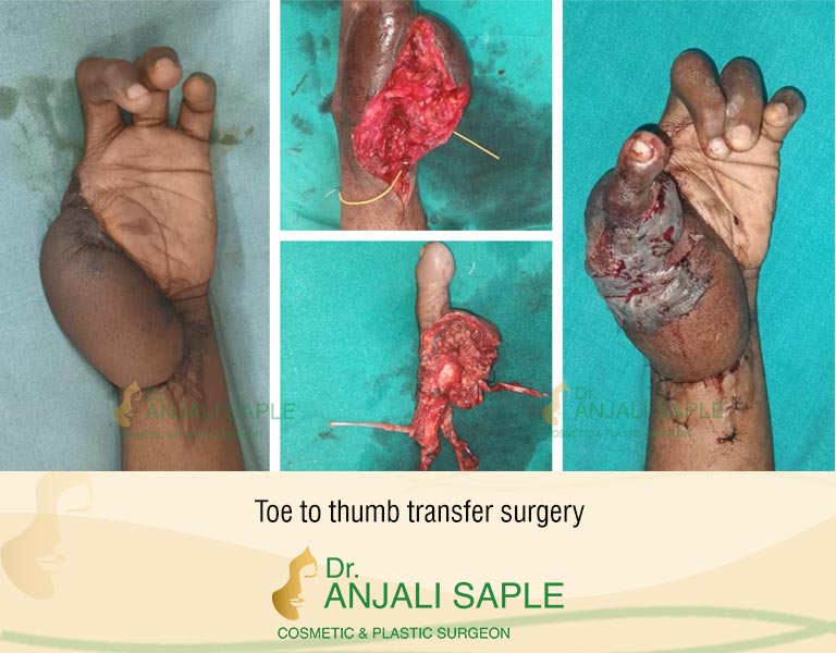 toe-to-thumb-transfer-surgery-before-after-by-Dr.Anjali-saple
