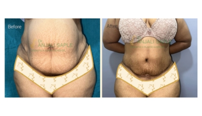 Case 1: Liposuction Front View