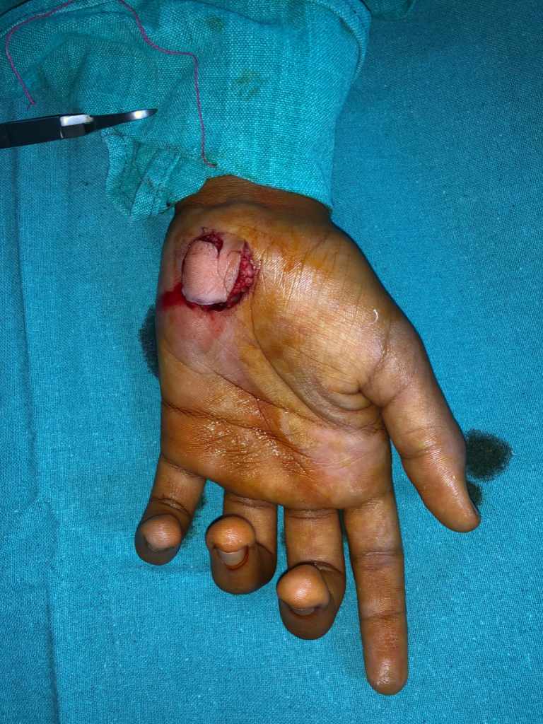 Aryan’s Hand Injury