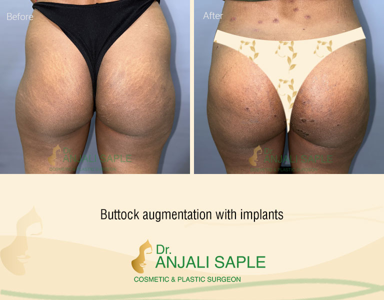 Before-After: Buttock Augmentation