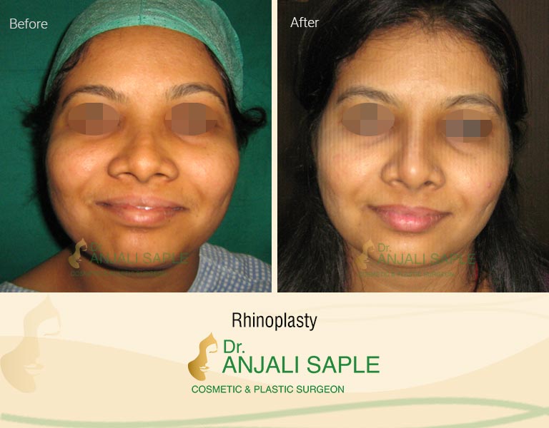 Rhinoplasty before and after image front view
