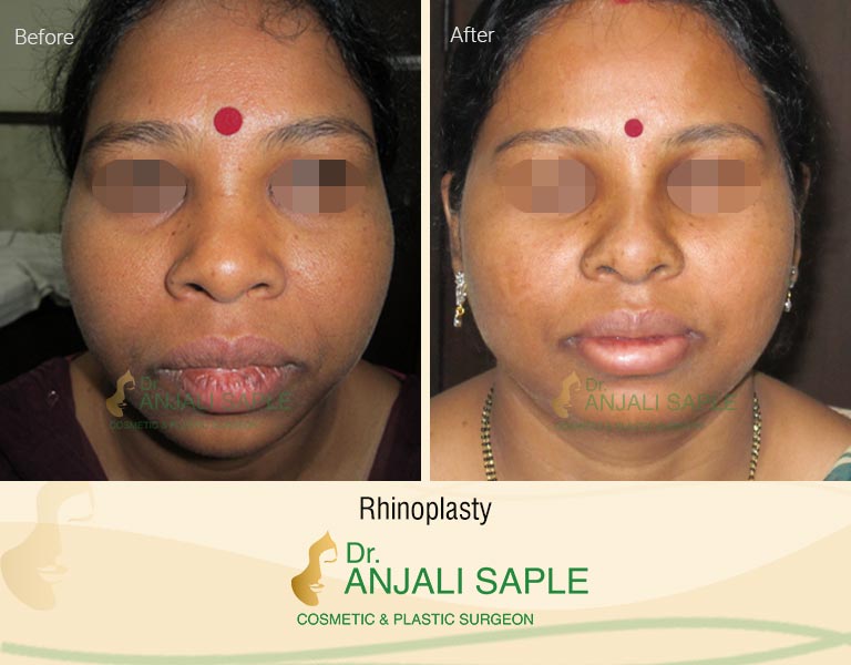 Rhinoplasty before and after images