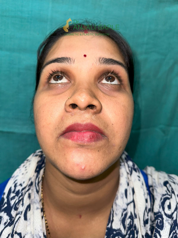 After 8 months post treatment facial reconstruction by Dr. Anjali Saple bottom-view