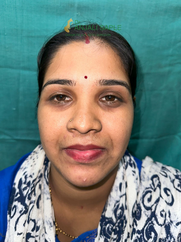 After 8 months post treatment facial reconstruction by Dr. Anjali Saple front-view