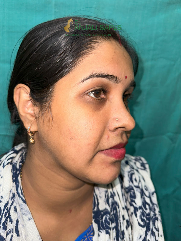 After 8 months post treatment facial reconstruction by Dr. Anjali Saple  side-view-2