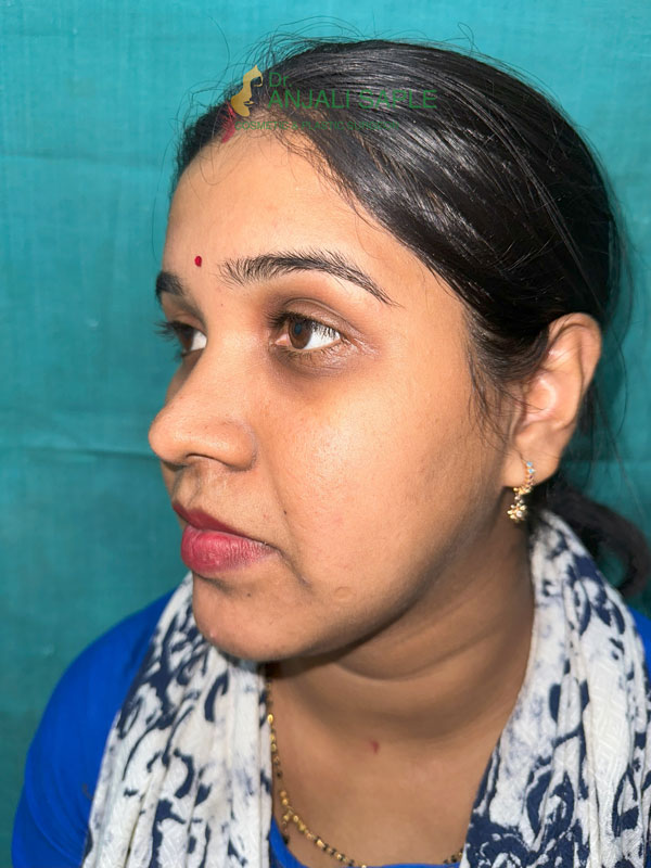 After 8 months post treatment facial reconstruction by Dr. Anjali Saple  side-view