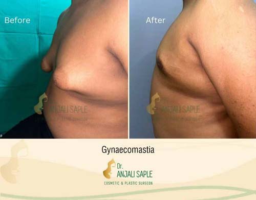 Tuberous breast left view by Aditya Singh