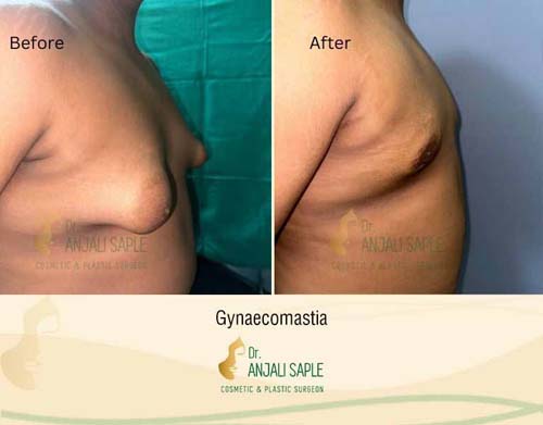 Tuberous breast right view by Aditya Singh