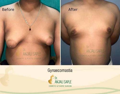 Tuberous breast case by Aditya Singh