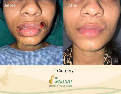 Lip injury case by Amulya