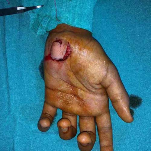 Aryan’s Hand Injury