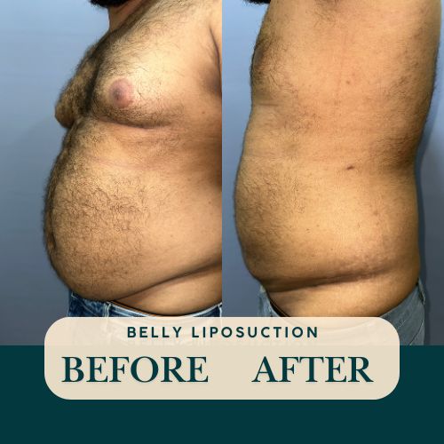 Belly liposuction