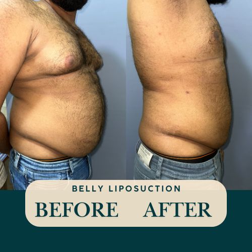 Abdomen liposuction