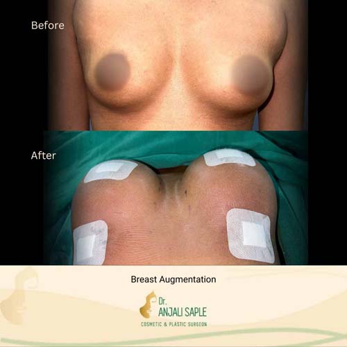 Breast Augmentation case 1