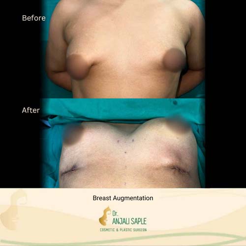 Breast Augmentation case 2