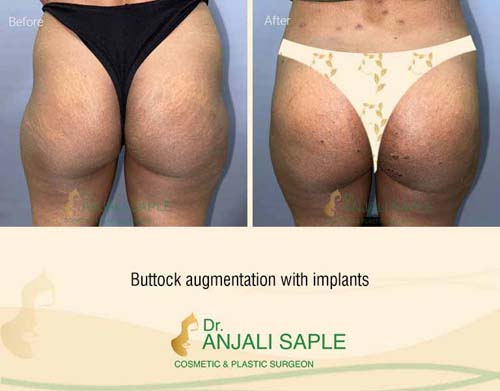 Before-After: Buttock Augmentation