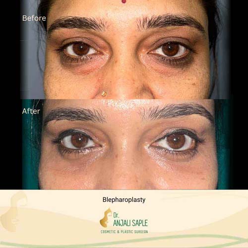 Eyelid surgery case 1, view 1