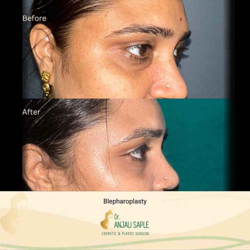 Eyelid surgery case 1, view 3