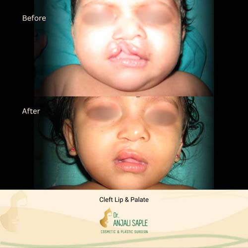 Cleft lip and palate surgery case 1