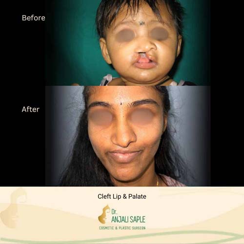 Cleft lip and palate surgery case 2, view 1