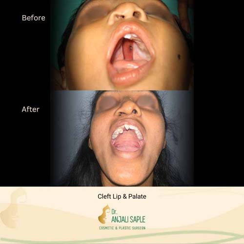 Cleft lip and palate surgery case 2, view 2