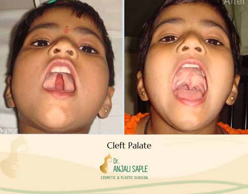 Cleft palate surgery case