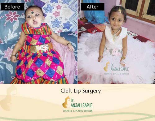 Cleft lip surgery case 7
