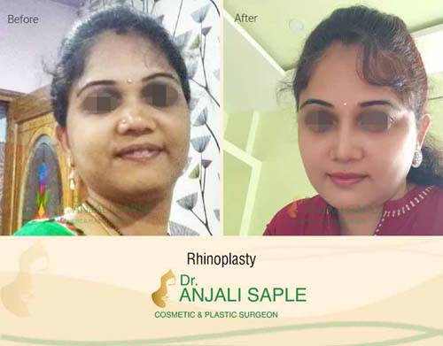 rhinoplasty before and after