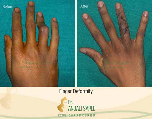 Finger deformity case by Dr. Anjali Saple