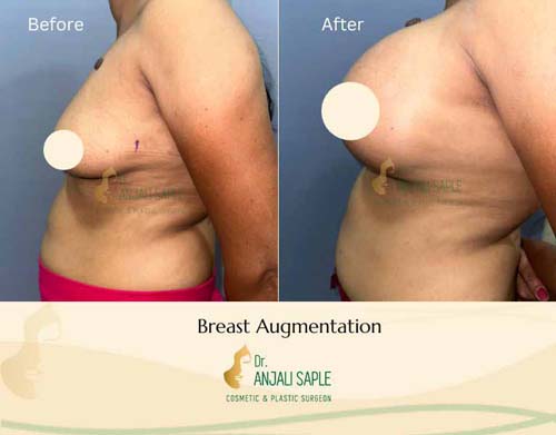Breast augmentation left view by Geeta Laxmi