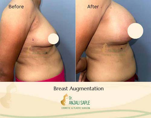 Breast augmentation right view by Geeta Laxmi