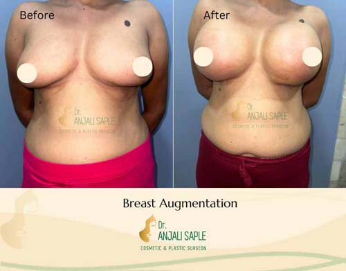 Breast augmentation case by Geeta Laxmi