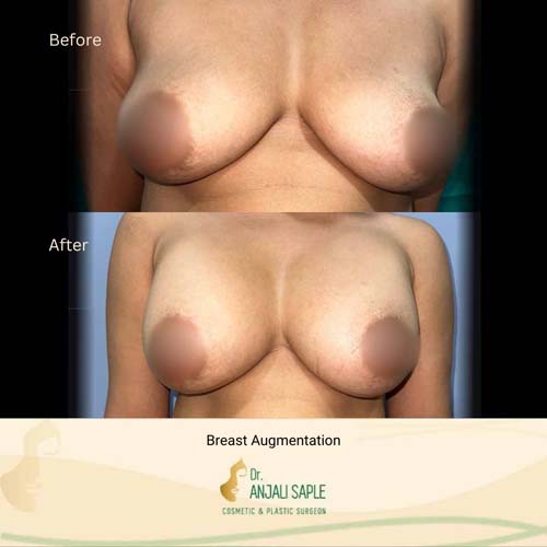 Breast augmentation by Geetha, view 1