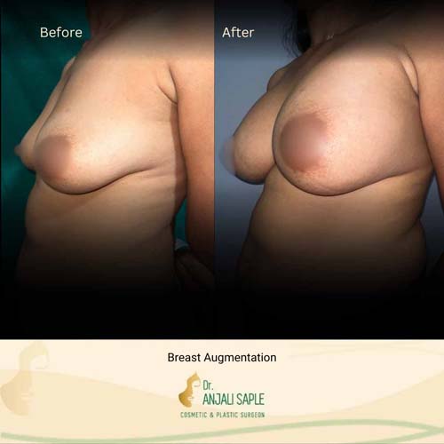 Breast augmentation by Geetha, view 2