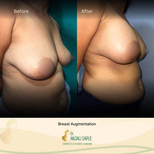 Breast augmentation by Geetha, view 3
