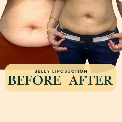 Belly Liposuction