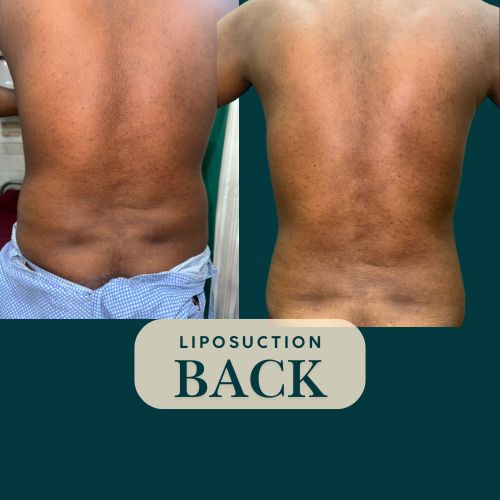Back Liposuction