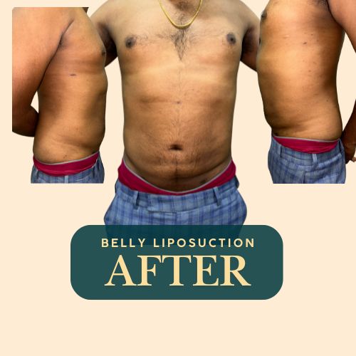 Belly liposuction