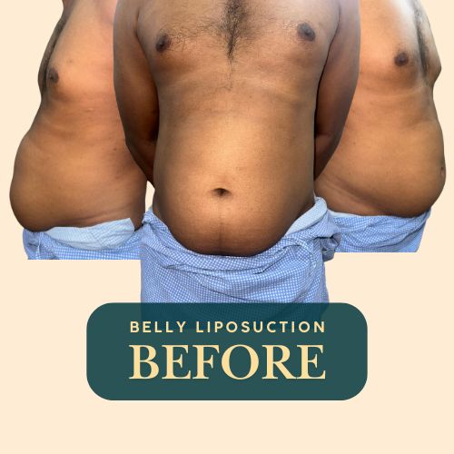 Belly liposuction