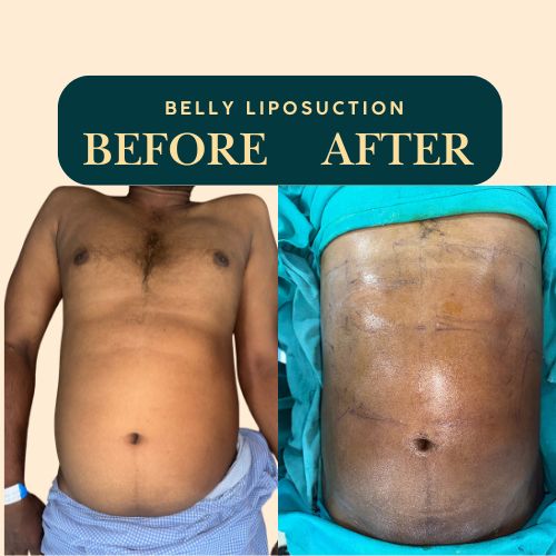 Abdomen liposuction