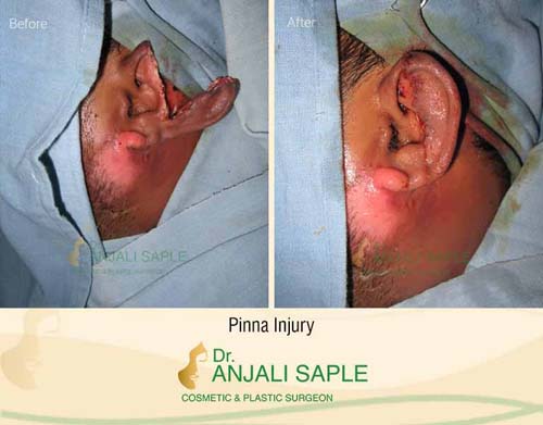 Ear injury case by Dr. Anjali Saple, case 1