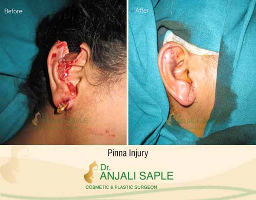 Ear injury case by Dr. Anjali Saple, case 2