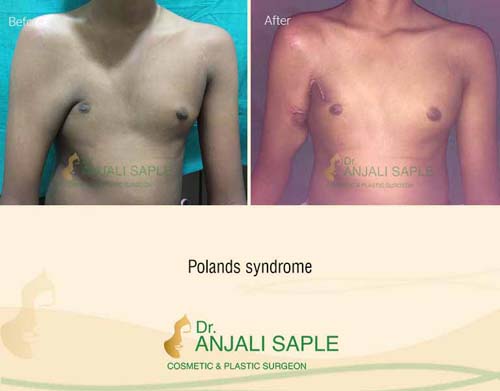 Polands syndrome surgery case by Dr. Anjali Saple