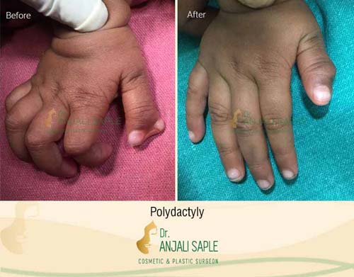 Polydactyly surgery case by Dr. Anjali Saple