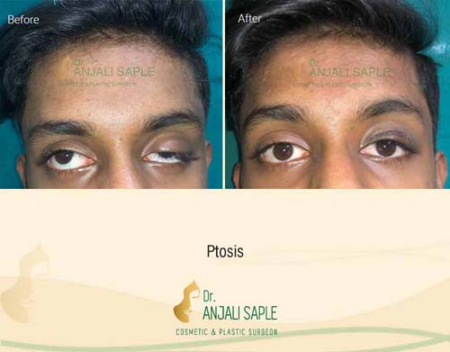 Ptosis surgery case by Dr. Anjali Saple