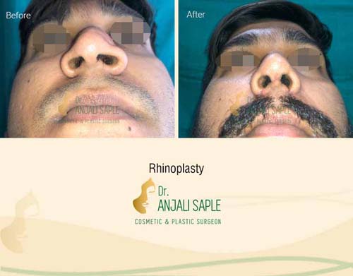 Rhinoplasty bottom view by Dr. Anjali Saple
